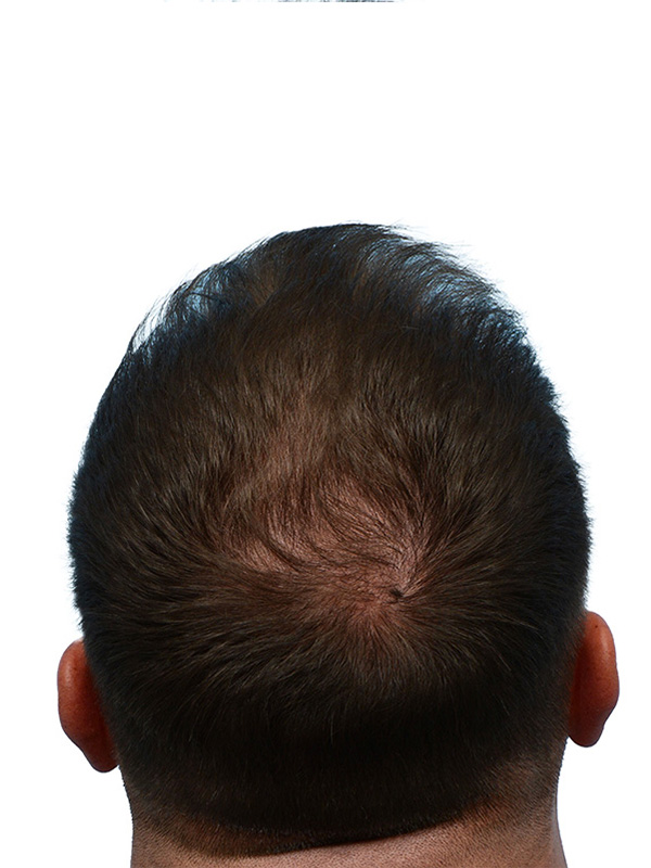 Fue Before and After | Dr. Jeffrey Wise