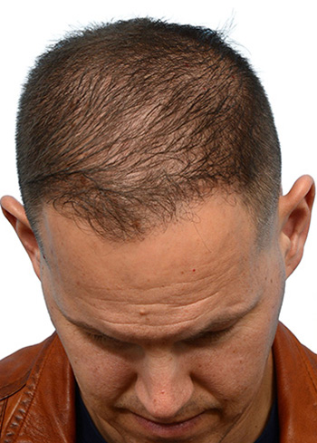 Fue Before and After | Dr. Jeffrey Wise