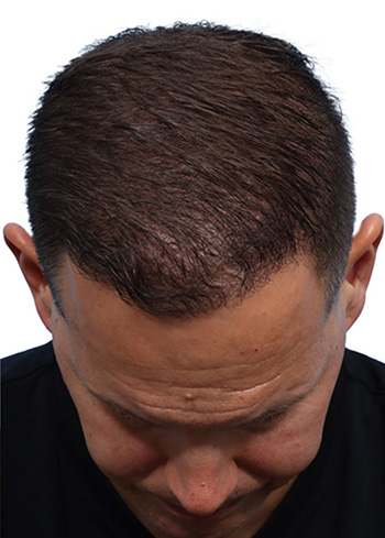 Fue Before and After | Dr. Jeffrey Wise