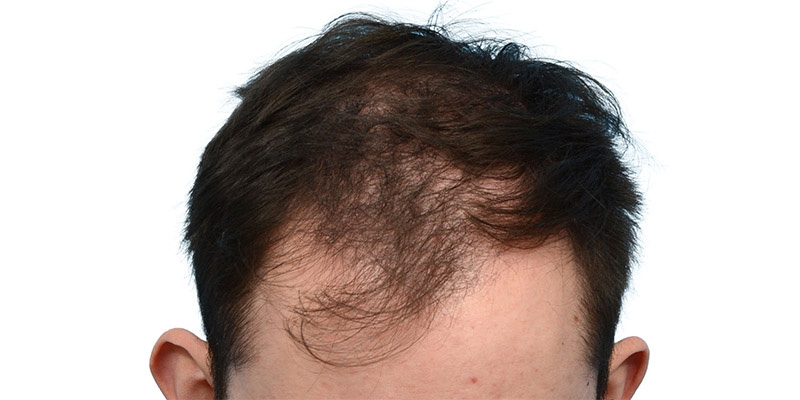 Fue Before and After | Dr. Jeffrey Wise