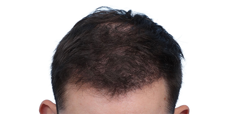 Fue Before and After | Dr. Jeffrey Wise