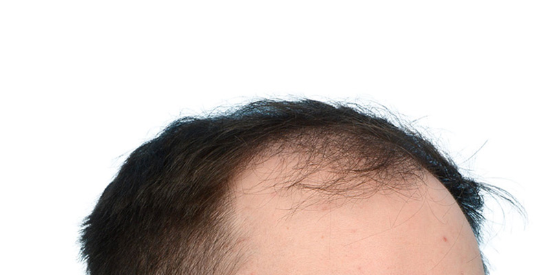 Fue Before and After | Dr. Jeffrey Wise