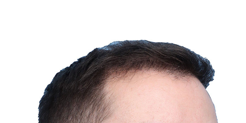 Fue Before and After | Dr. Jeffrey Wise