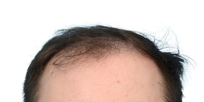 Fue Before and After | Dr. Jeffrey Wise