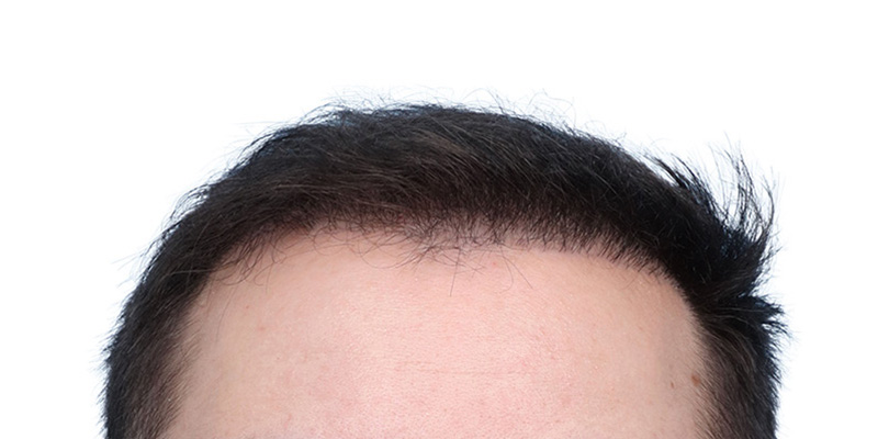 Fue Before and After | Dr. Jeffrey Wise