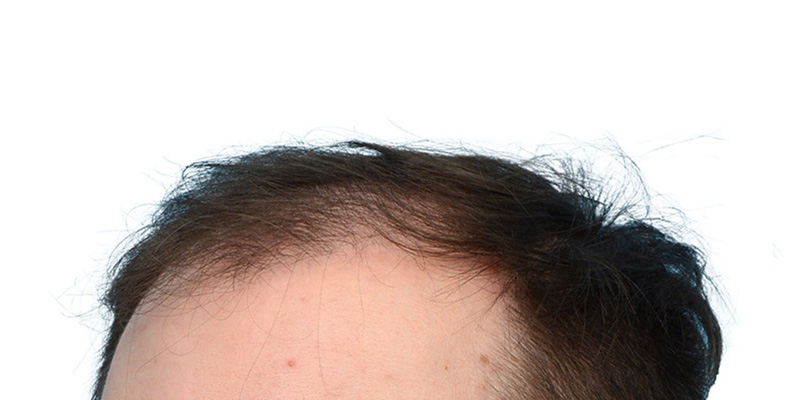 Fue Before and After | Dr. Jeffrey Wise