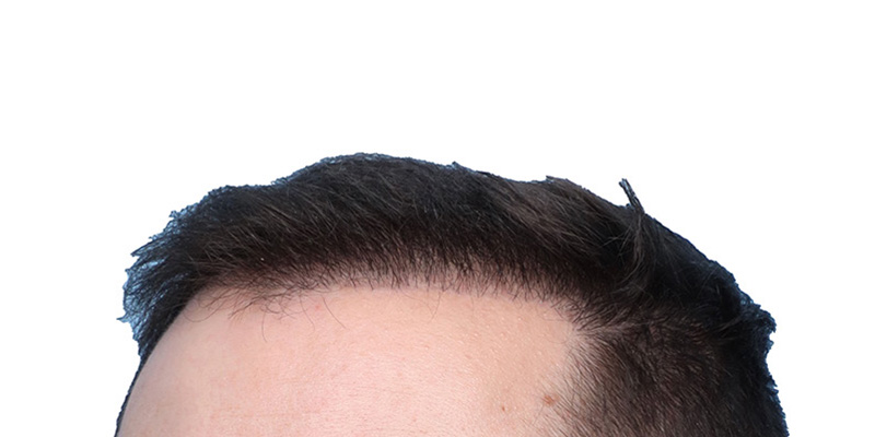 Fue Before and After | Dr. Jeffrey Wise