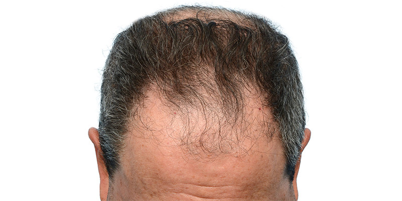 Fue Before and After | Dr. Jeffrey Wise