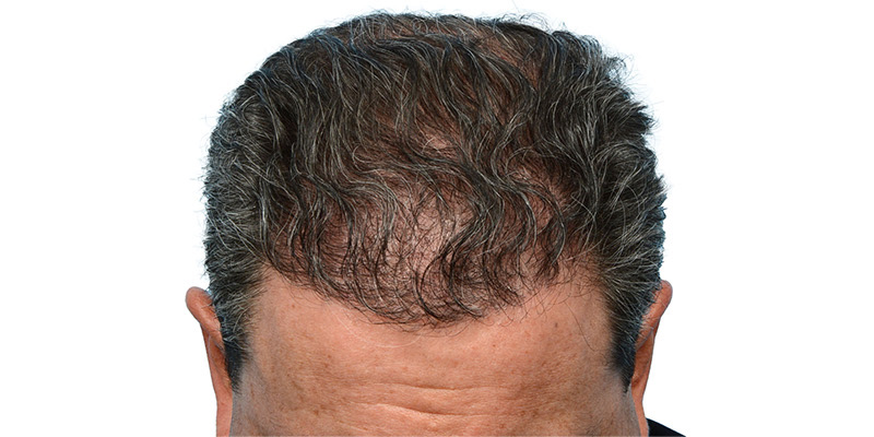 Fue Before and After | Dr. Jeffrey Wise