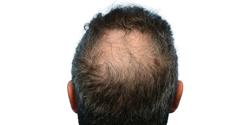 Fue Before and After | Dr. Jeffrey Wise