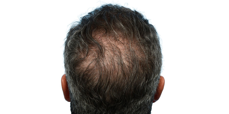 Fue Before and After | Dr. Jeffrey Wise