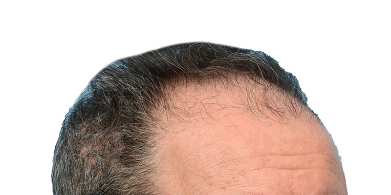 Fue Before and After | Dr. Jeffrey Wise