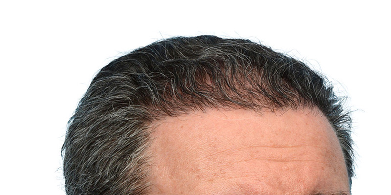 Fue Before and After | Dr. Jeffrey Wise