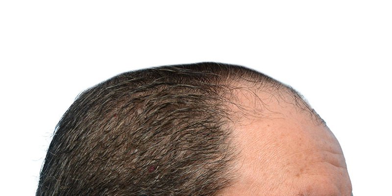 Fue Before and After | Dr. Jeffrey Wise