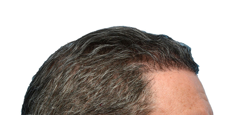 Fue Before and After | Dr. Jeffrey Wise