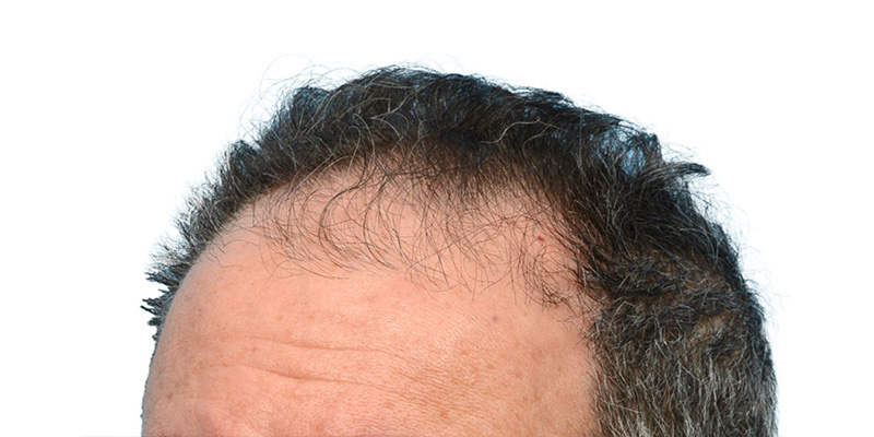 Fue Before and After | Dr. Jeffrey Wise