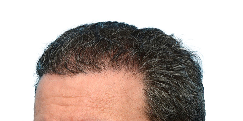 Fue Before and After | Dr. Jeffrey Wise