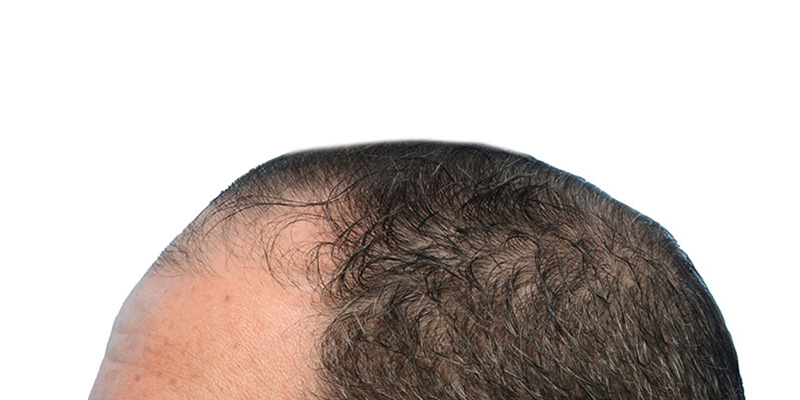 Fue Before and After | Dr. Jeffrey Wise