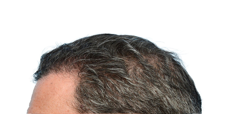 Fue Before and After | Dr. Jeffrey Wise