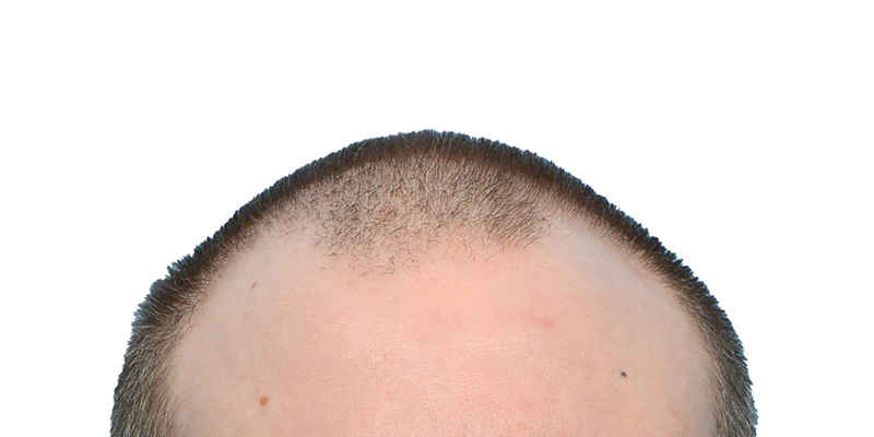 Fue Before and After | Dr. Jeffrey Wise