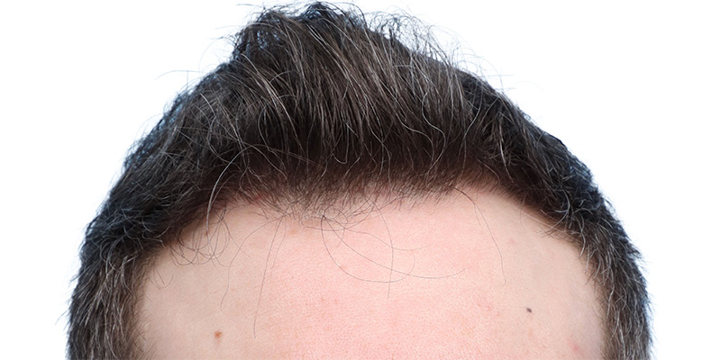 Fue Before and After | Dr. Jeffrey Wise