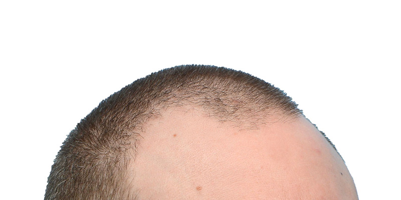 Fue Before and After | Dr. Jeffrey Wise