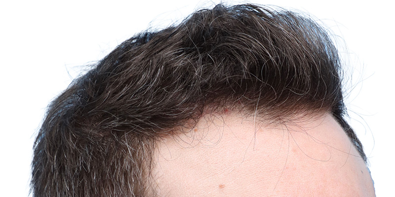 Fue Before and After | Dr. Jeffrey Wise