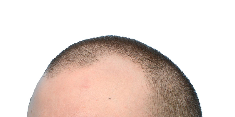 Fue Before and After | Dr. Jeffrey Wise