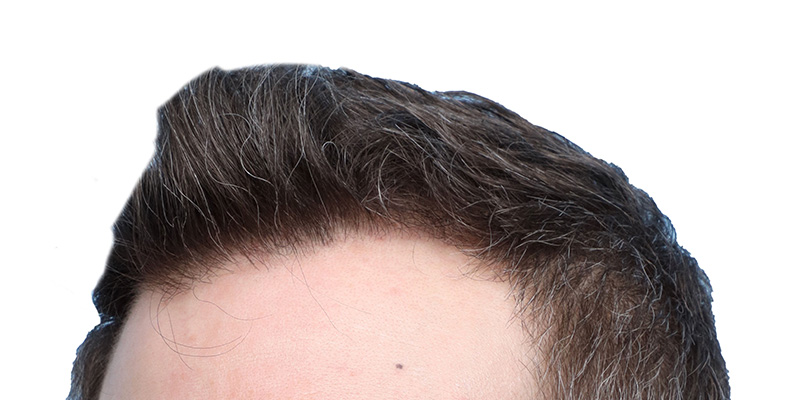 Fue Before and After | Dr. Jeffrey Wise