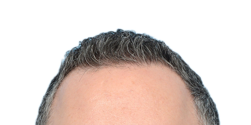 Fue Before and After | Dr. Jeffrey Wise