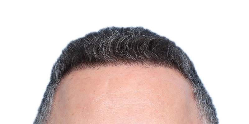 Fue Before and After | Dr. Jeffrey Wise