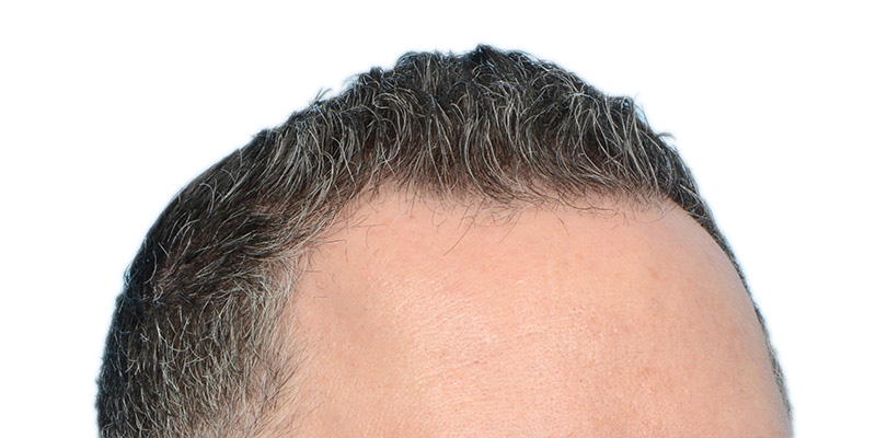 Fue Before and After | Dr. Jeffrey Wise