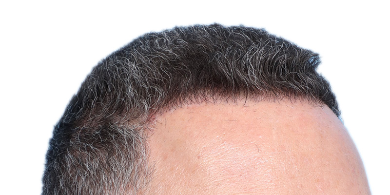 Fue Before and After | Dr. Jeffrey Wise