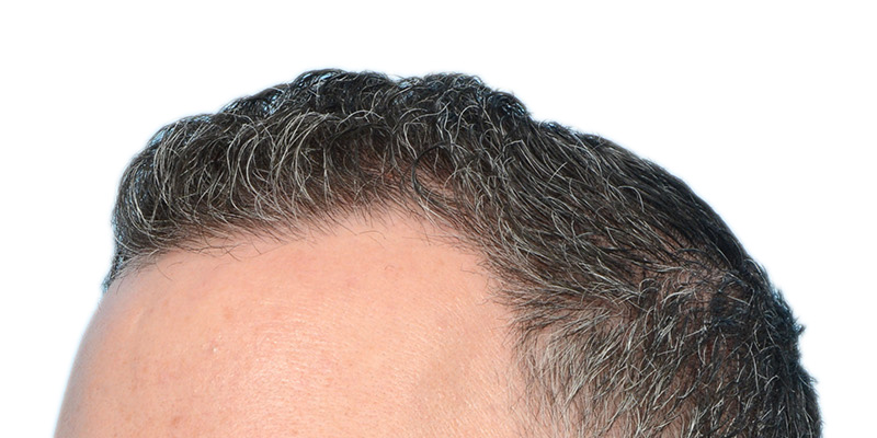 Fue Before and After | Dr. Jeffrey Wise