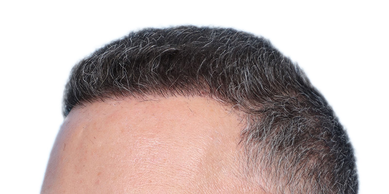 Fue Before and After | Dr. Jeffrey Wise