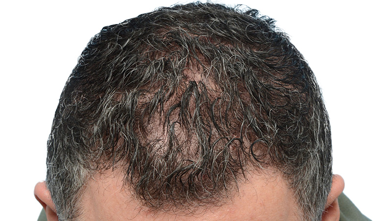 Fue Before and After | Dr. Jeffrey Wise