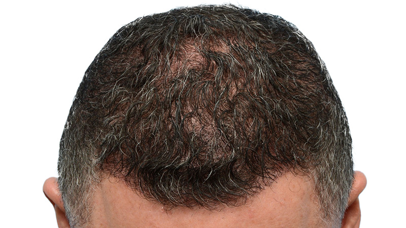 Fue Before and After | Dr. Jeffrey Wise