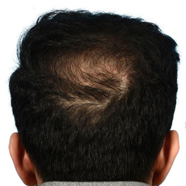 Fue Before and After | Dr. Jeffrey Wise