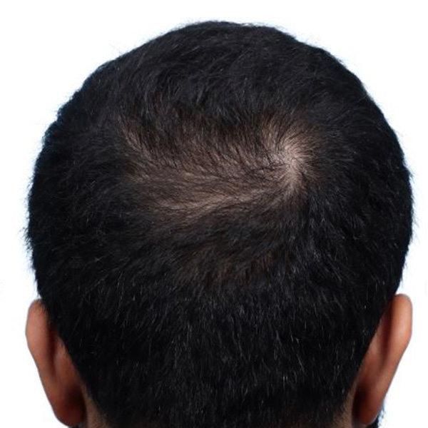 Fue Before and After | Dr. Jeffrey Wise