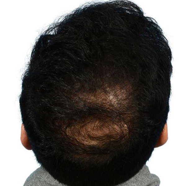 Fue Before and After | Dr. Jeffrey Wise