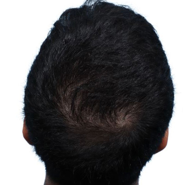 Fue Before and After | Dr. Jeffrey Wise