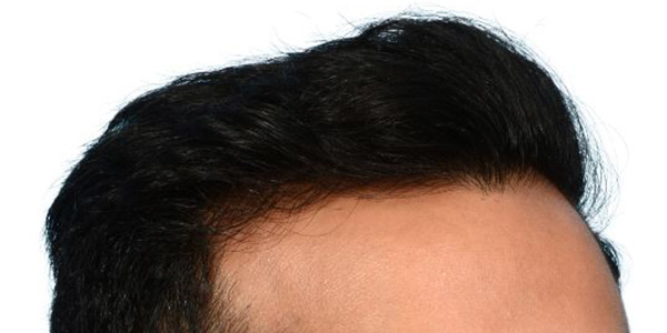 Fue Before and After | Dr. Jeffrey Wise