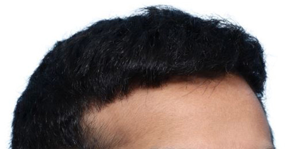 Fue Before and After | Dr. Jeffrey Wise