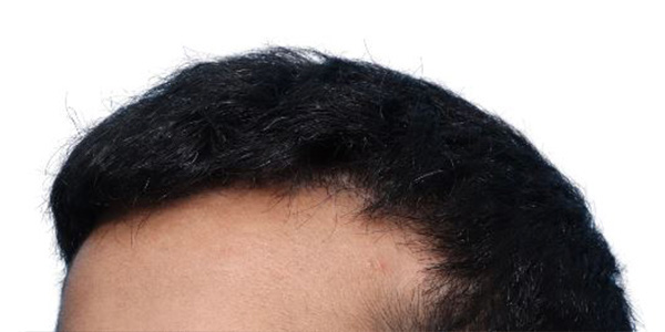 Fue Before and After | Dr. Jeffrey Wise