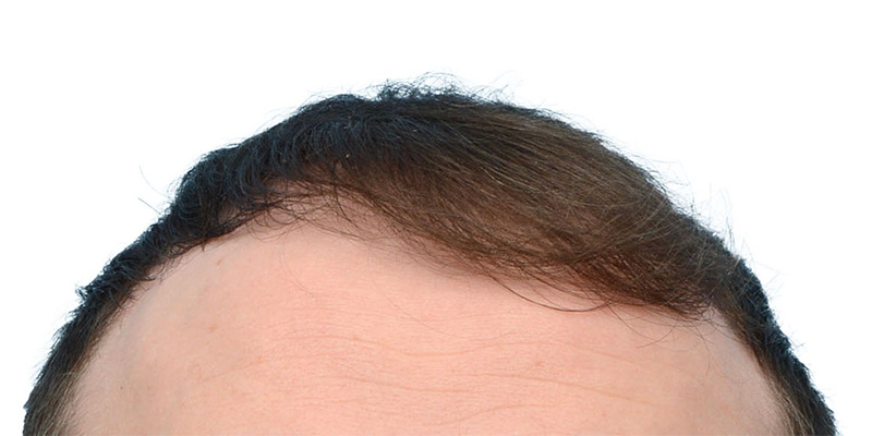 Fue Before and After | Dr. Jeffrey Wise