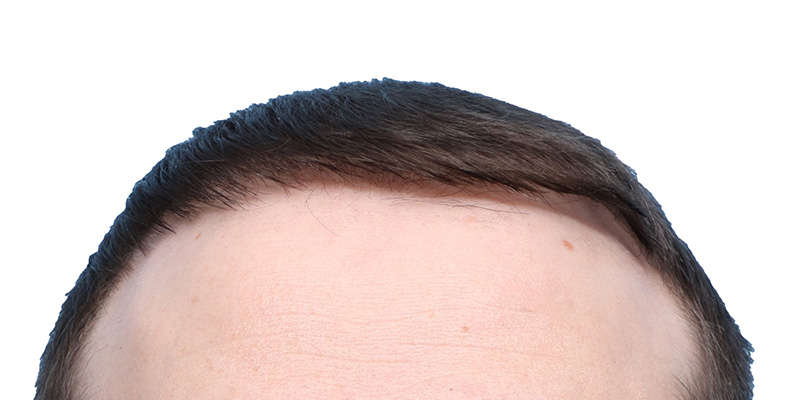 Fue Before and After | Dr. Jeffrey Wise