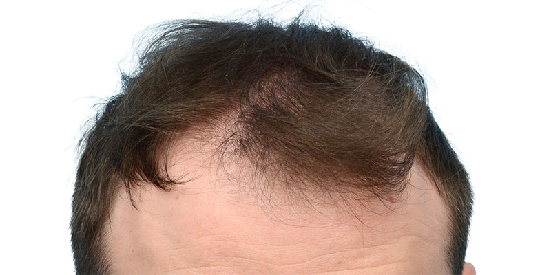 Fue Before and After | Dr. Jeffrey Wise