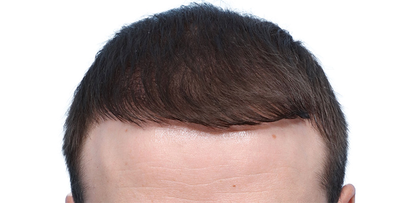 Fue Before and After | Dr. Jeffrey Wise