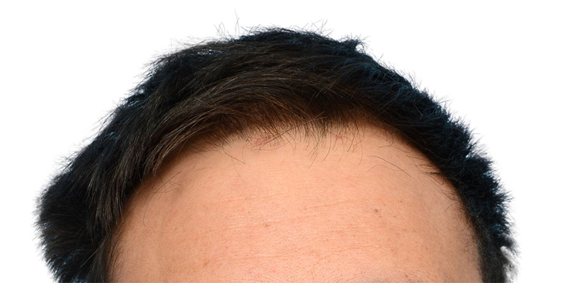 Fue Before and After | Dr. Jeffrey Wise