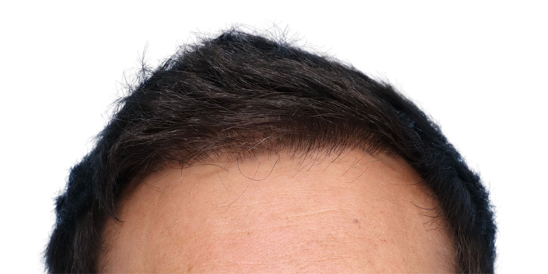 Fue Before and After | Dr. Jeffrey Wise